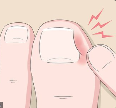 Alicate Para Desencravar Unhas
